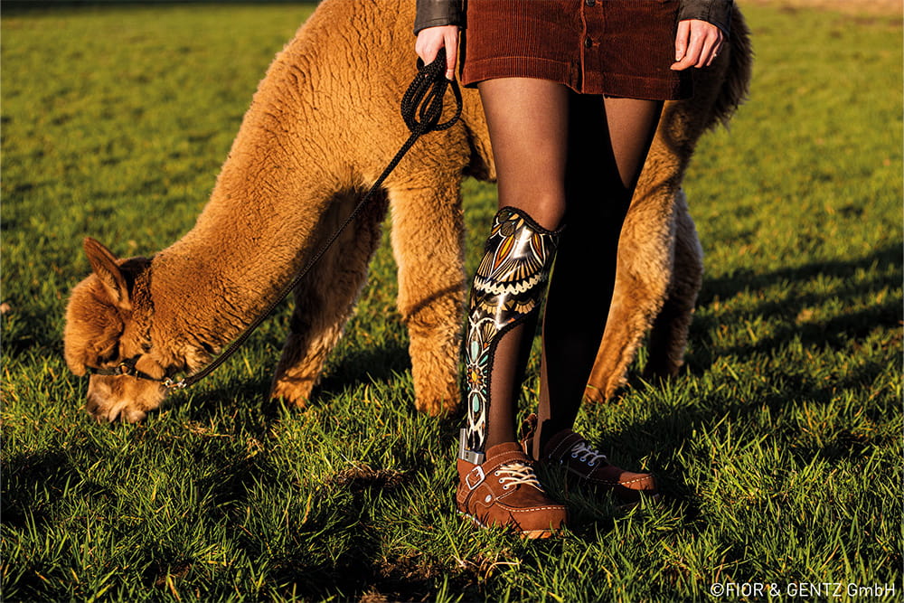 A woman with a lower leg orthosis stands next to an alpaca in a meadow.